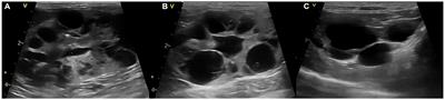 Case report: A novel occurrence of persistent left cranial vena cava coexisting with polycystic kidney disease in a cat